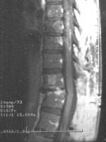 ruptured disc between thoracic vertebrae 11 and 12 in the center of Ruth's back