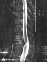 whiteness at pinched spinal cord indicates swelling